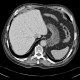 Amiodarone deposition in liver parenchyma: CT - Computed tomography