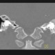 Axis, C2, development of vertebra: CT - Computed tomography