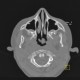 Axis, C2, development of vertebra: CT - Computed tomography
