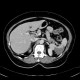 Splenic infarction, development in time: CT - Computed tomography