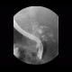 Choledochal diverticulum, ERCP: RF - Fluoroscopy