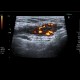 Varices in groin, inguinal canal: US - Ultrasound