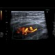 Varices in groin, inguinal canal: US - Ultrasound