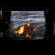 Varices in groin, inguinal canal: US - Ultrasound