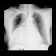 Cardiomegally, azygous vein: X-ray - Plain radiograph