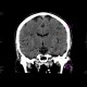 Early changes of brain ischemia, MCA: CT - Computed tomography