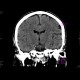Early changes of brain ischemia, MCA: CT - Computed tomography