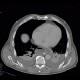 Pneumoperitoneum, mimic of epiphrenic diverticulum: CT - Computed tomography