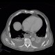 Pneumoperitoneum, mimic of epiphrenic diverticulum: CT - Computed tomography