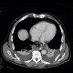Pneumoperitoneum, mimic of epiphrenic diverticulum: CT - Computed tomography