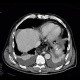 Pneumoperitoneum, mimic of epiphrenic diverticulum: CT - Computed tomography