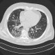 Wegener's granulomatosis, sequelae of alveolar hemorrhage: CT - Computed tomography