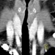 Wegener's granulomatosis of trachea: CT - Computed tomography