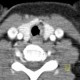 Wegener's granulomatosis of trachea: CT - Computed tomography