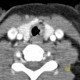 Wegener's granulomatosis of trachea: CT - Computed tomography