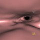 Wegener's granulomatosis of trachea, virtual endoscopy: CT - Computed tomography