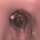Wegener's granulomatosis of trachea, virtual endoscopy: CT - Computed tomography