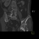 Coxarthrosis, Wiberg's sign: CT - Computed tomography