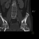 Coxarthrosis, Wiberg's sign: CT - Computed tomography
