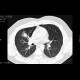 Wegener's granulomatosis, HRCT: CT - Computed tomography