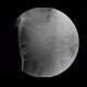 Whipple procedure, hepatico-jejuno anastomosis, biliary ascites, leak of anastomosis: RF - Fluoroscopy