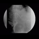 Whipple procedure, hepatico-jejuno anastomosis, biliary ascites, leak of anastomosis: RF - Fluoroscopy