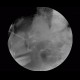 Whipple procedure, hepatico-jejuno anastomosis, biliary ascites, leak of anastomosis: RF - Fluoroscopy