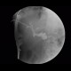Whipple procedure, hepatico-jejuno anastomosis, biliary ascites, leak of anastomosis: RF - Fluoroscopy