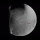 Whipple procedure, hepatico-jejuno anastomosis, biliary ascites, leak of anastomosis: RF - Fluoroscopy