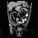 Wirsungolithiasis: CT - Computed tomography