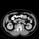 Duplication of inferior vena cava, VCI: CT - Computed tomography
