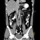 Duplication of inferior vena cava, VCI: CT - Computed tomography