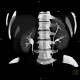 Duplication of collecting system of kidney, ureter fissus: CT - Computed tomography