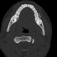 Chewing gum in vestibule of the mouth: CT - Computed tomography