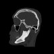 Chewing gum in vestibule of the mouth: CT - Computed tomography