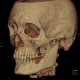 Chewing gum in vestibule of the mouth, VRT: CT - Computed tomography