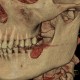 Chewing gum in vestibule of the mouth, VRT: CT - Computed tomography
