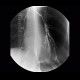 Aspiration of contrast, dysphagia: RF - Fluoroscopy