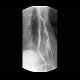 Aspiration of contrast, dysphagia: RF - Fluoroscopy