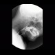 Aspiration of contrast, dysphagia: RF - Fluoroscopy