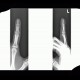 Thickening of nail bed: X-ray - Plain radiograph