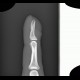 Thickening of nail bed: X-ray - Plain radiograph