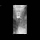 Zenker's diverticulum of the oesophagus: RF - Fluoroscopy