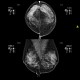 Glandular type, normal mammography, : X-ray - Plain radiograph