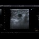 Marking of a breast tumour: US - Ultrasound