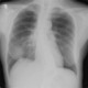 Adrenal metastasis and skeletal metastasis of pulmonary carcinoma, correlation, initial examination: X-ray - Plain radiograph