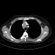 Adrenal metastasis and skeletal metastasis of pulmonary carcinoma, correlation, initial examination: CT - Computed tomography