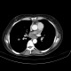 Adrenal metastasis and skeletal metastasis of pulmonary carcinoma, correlation, initial examination: CT - Computed tomography