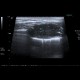 Adrenal metastasis and skeletal metastasis of pulmonary carcinoma, correlation: US - Ultrasound