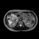 Polyp in jejunum, jejunal polyps, polyposis: MRI - Magnetic Resonance Imaging
